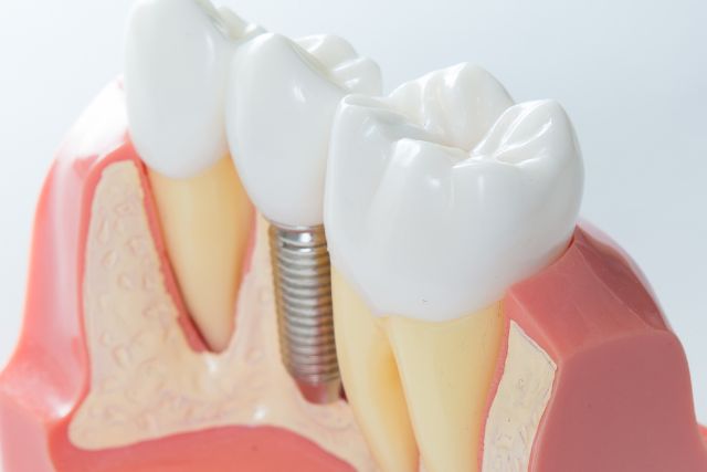 Implantes dentales Antes o después de la ortodoncia