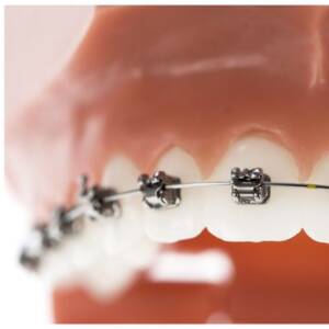 ortodoncia antes de implantes