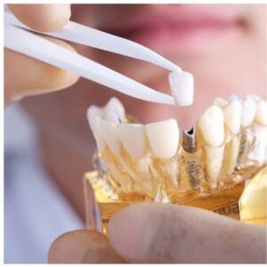 implante dental alaquas y valencia