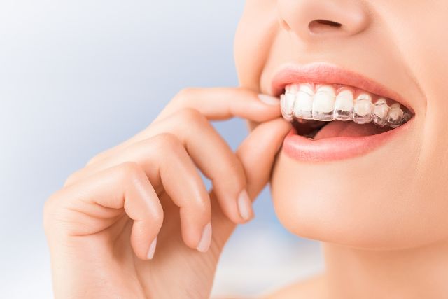 Cómo limpiar la Ortodoncia invisible? - Dentista Conrado Andrés