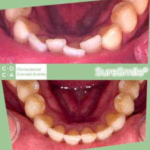 ortodoncia antes y despues