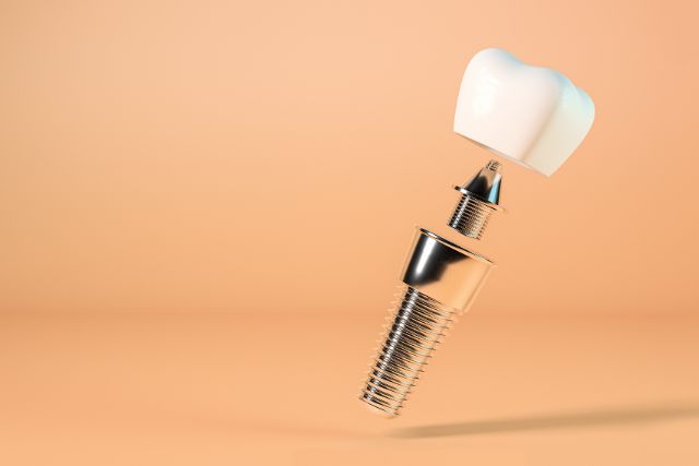 Implantes Dentales Preguntas Frecuentes