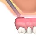 Atrofia Ósea Maxilar – Implantes Dentales Cigomáticos