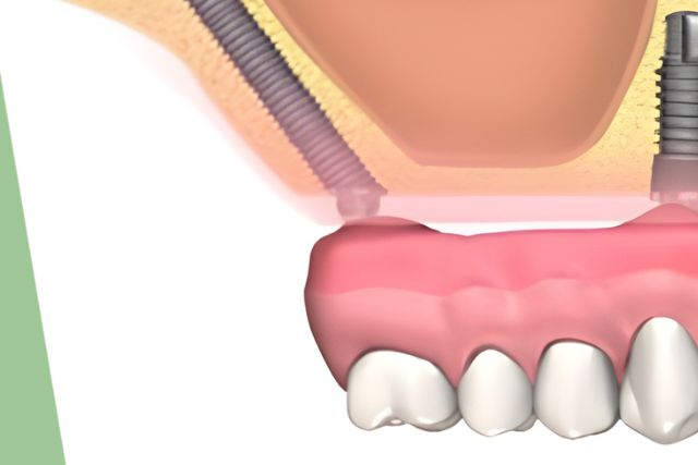 Atrofia Ósea Maxilar - Implantes Dentales Cigomáticos