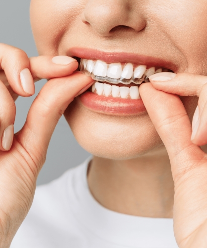 Ortodoncia invisible + Blanqueamiento dental Gratis