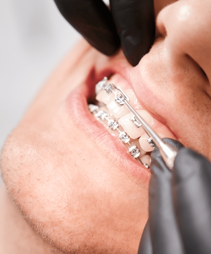 Ortodoncia + Blanqueamiento dental Gratis