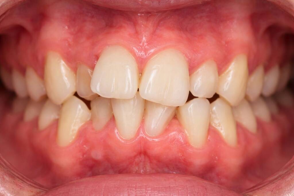 Mandíbula con dientes apiñados