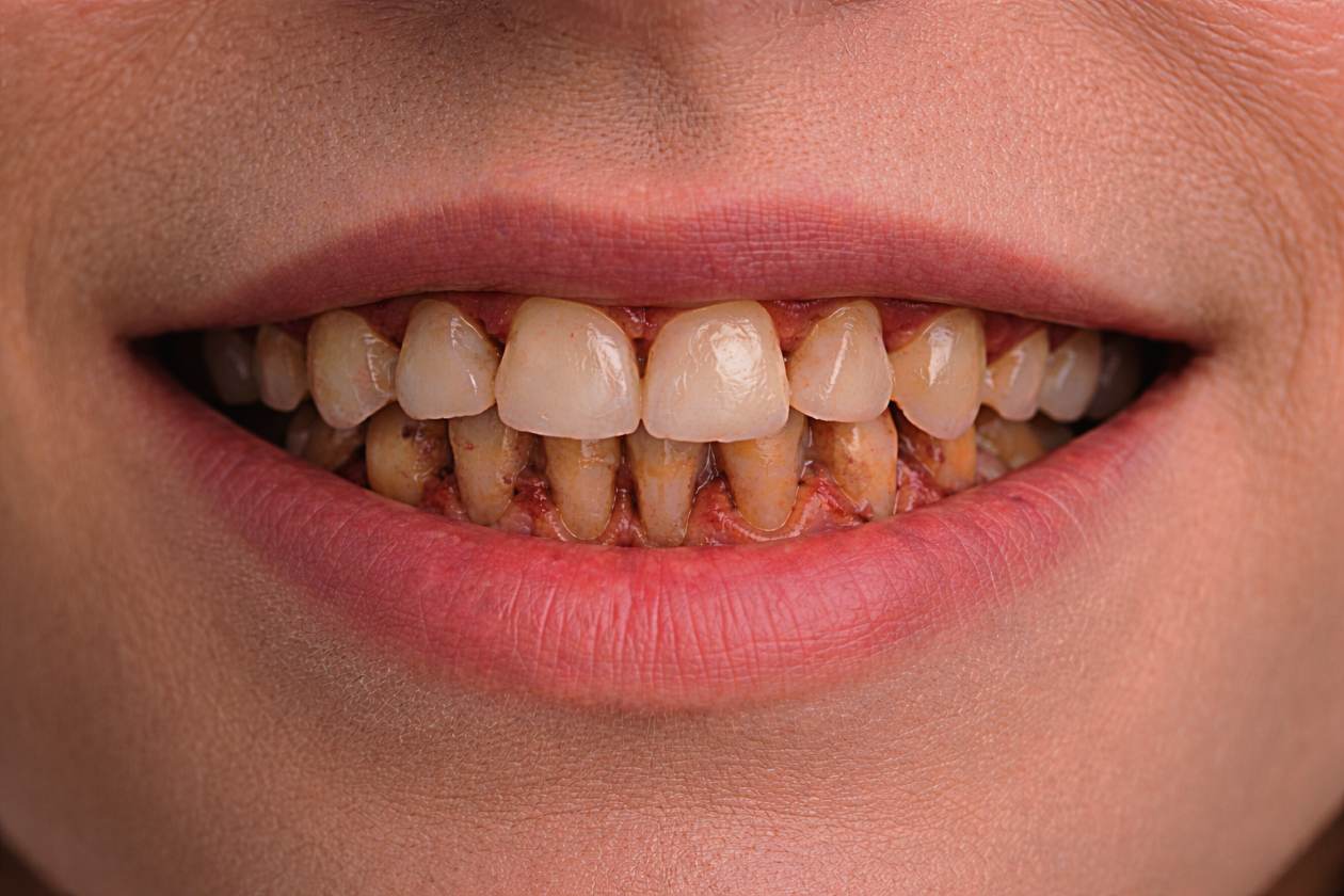 Enfermedad periodontal adulta