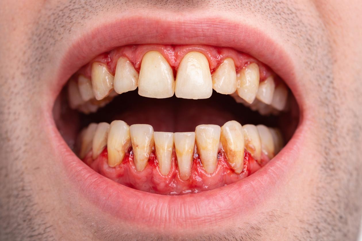 Enfermedad periodontal