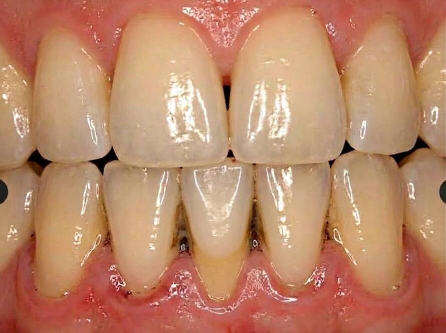 enfermedad periodontal severa