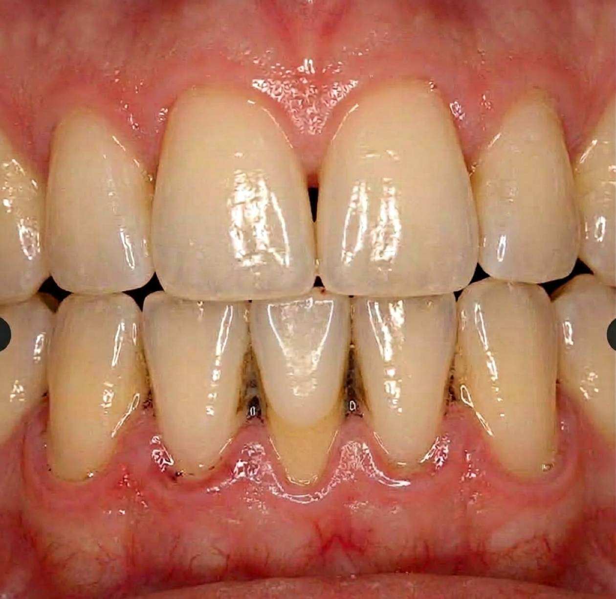 enfermedad periodontal severa