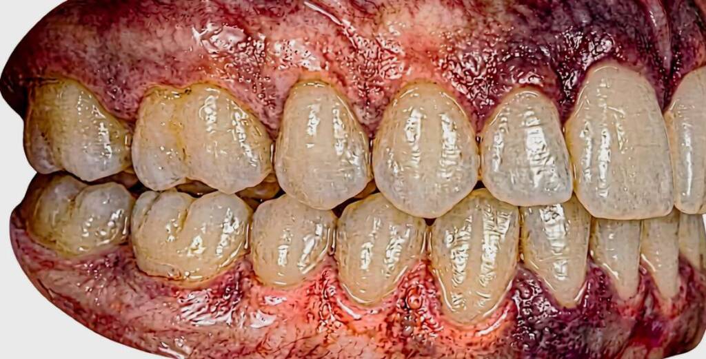 perfil de encía morada