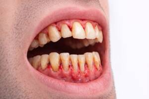 vista enfermedad periodontal avanzada