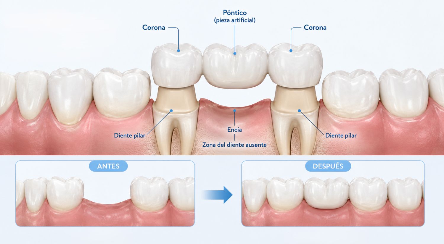 Puente dental fijo