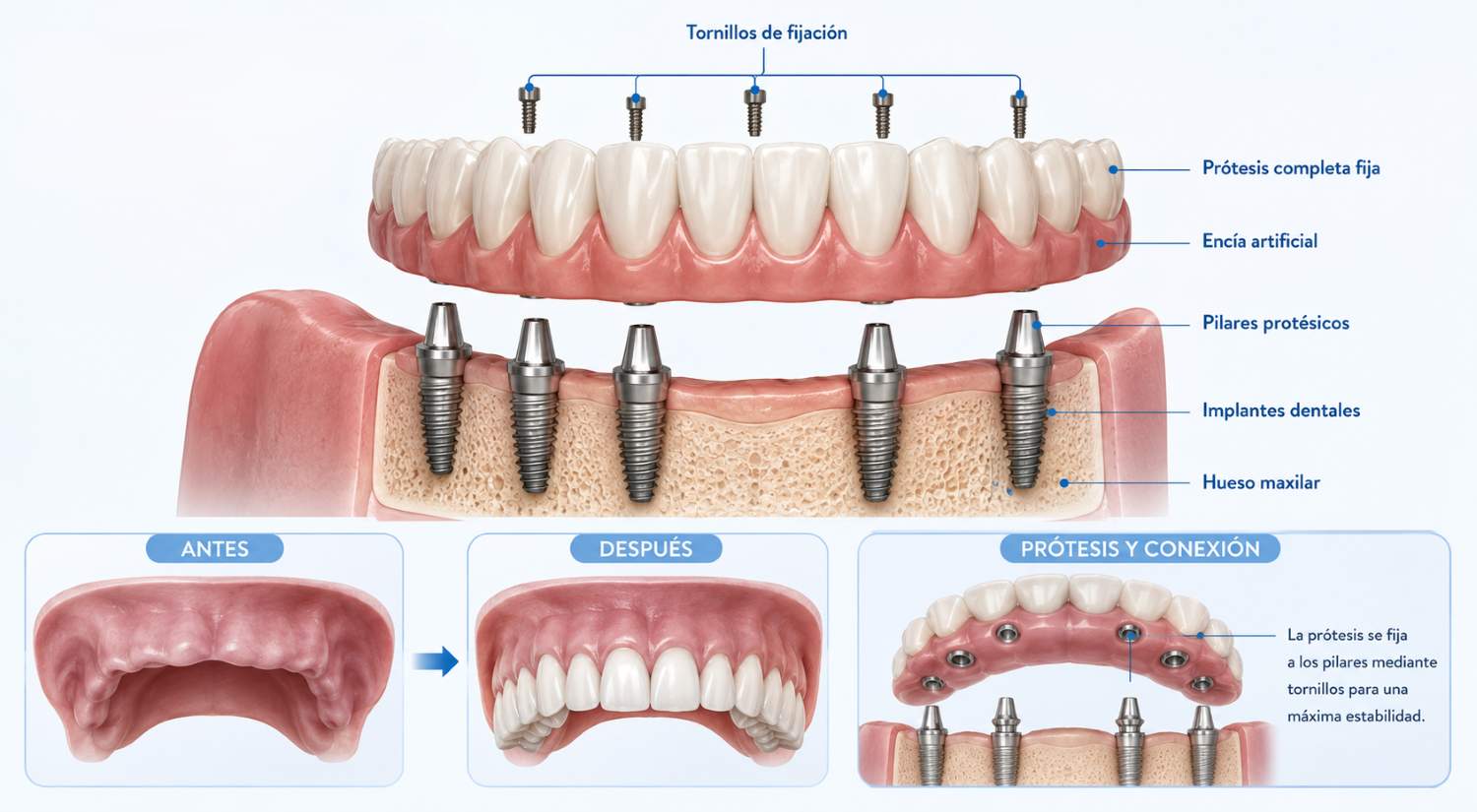 protesis completa fija sobre implantes