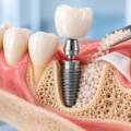 Implante dental con injerto de hueso: Cuándo es necesario y cómo se realiza