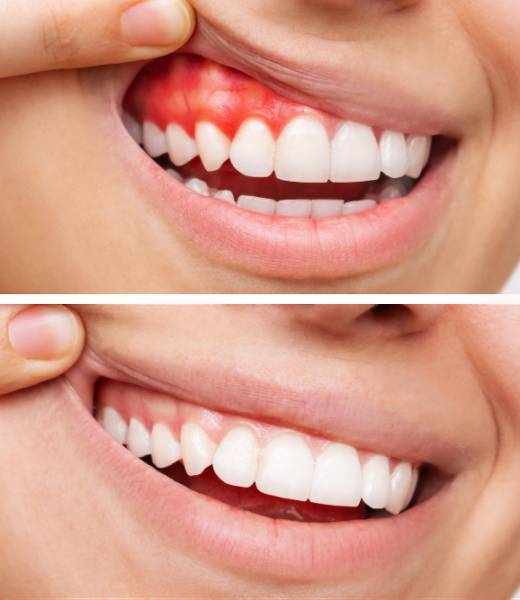 Tratamiento de cirugía facial: Sonrisa gingival